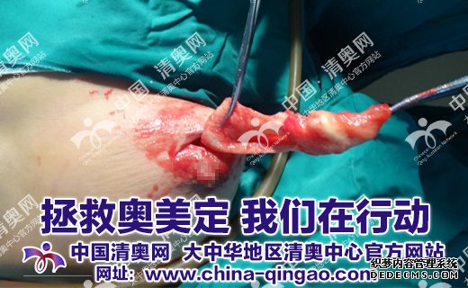 奥美定致癌